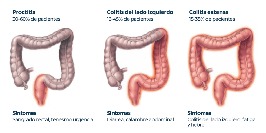 EL SÍNDROME DE INTESTINO IRRITABLE (SII) ES CONOCIDO POPULARMENTE COMO&nbsp;COLITIS